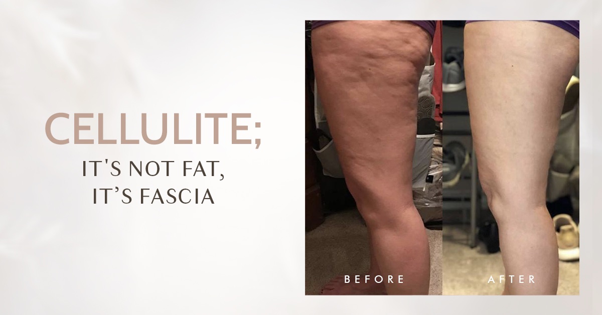 Manchester New Hampshire Spa Fascia Cellulite