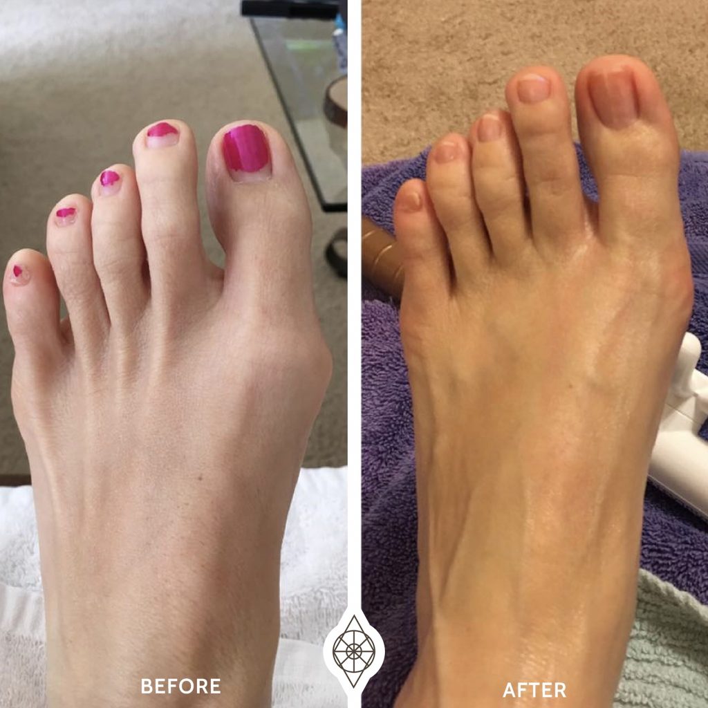 Manchester New Hampshire Spa Fascia Plantar Fascitis 1024x1024